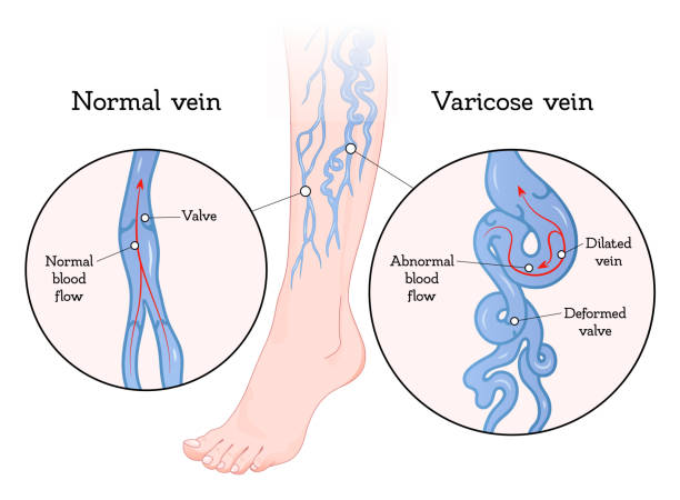 Varicose veins poster Varicose veins poster. Vein enlarged and twisted, blue blood vessel visible through the skin, abnormally swollen leg. Vector flat style cartoon illustration isolated on white background varicose vein stock illustrations