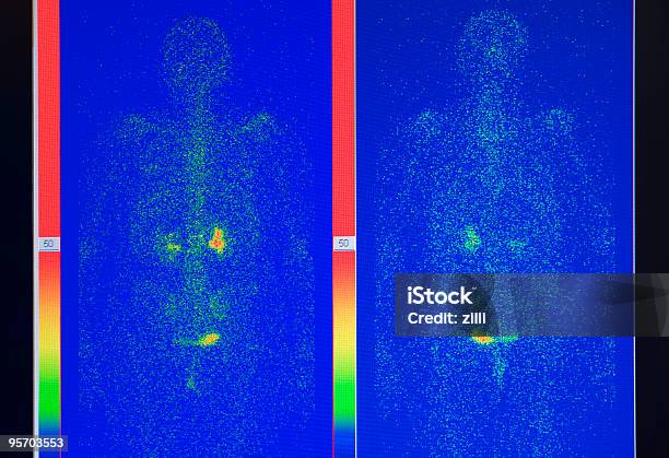 X선 영상 감마 스캔에 대한 스톡 사진 및 기타 이미지 - 감마 스캔, PET 스캔, CAT 스캔