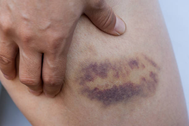 istock people with wounded leg holding in hands 957139438