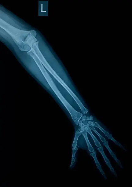 Photo of X-ray image of left arm and hand