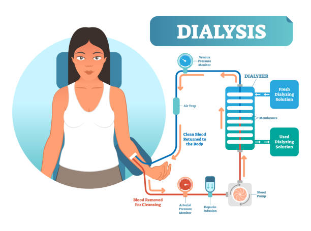 illustrations, cliparts, dessins animés et icônes de diagramme d’illustration de dialyse procédure médicale système vectoriel. filtrage de sang en cas de dysfonctionnement rénal. - renal vein