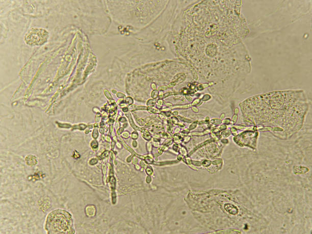 spirande jästceller i patientens urin - klamydiatest bildbanksfoton och bilder