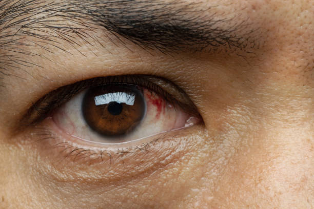 istock Blood in the eye from a subconjunctival hemorrhage 957480092