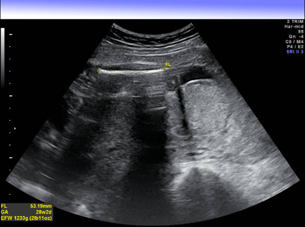 istock Ultrasound Obstetrical One Fetus Plus Doppler 957519590