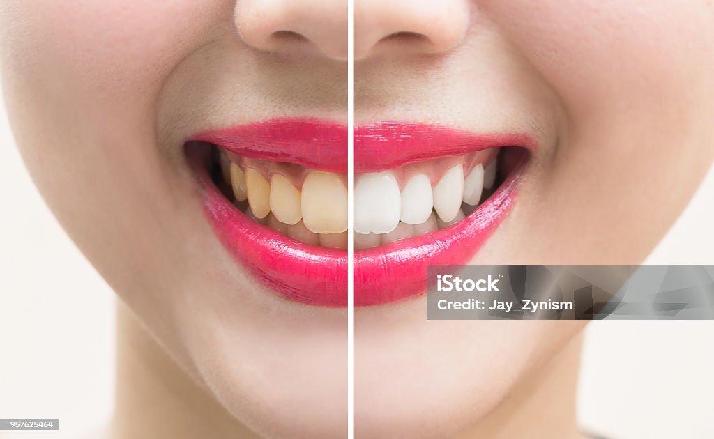 Dents de sourire parfait avant et après le blanchiment. concept de blanchiment des dents - Photo de Dents libre de droits