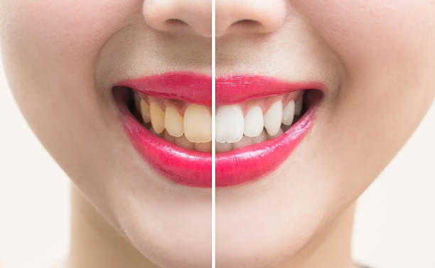 istock Perfect smile teeth before and after bleaching. whitening teeth concept 957625464