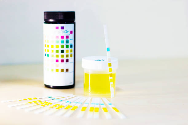 istock urine sample along with dip stick uristix for analyzing urine glucose protein in diabetes 957698746