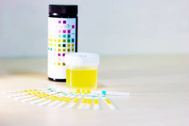 istock urine sample along with dip stick uristix for analyzing urine glucose protein in diabetes 957698768