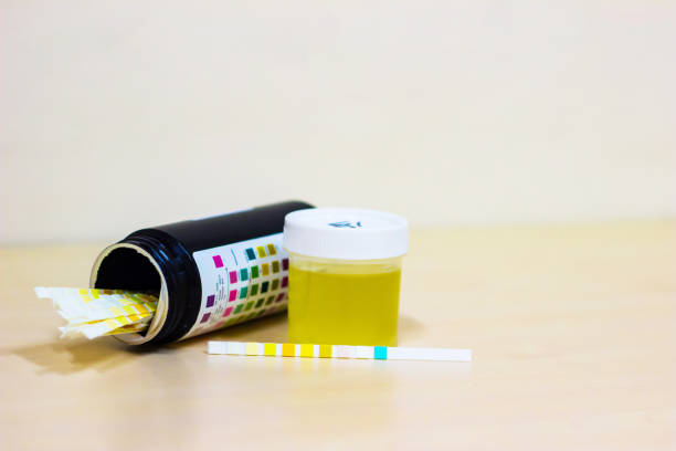 istock urine sample along with dip stick uristix for analyzing urine glucose protein in diabetes 957698786