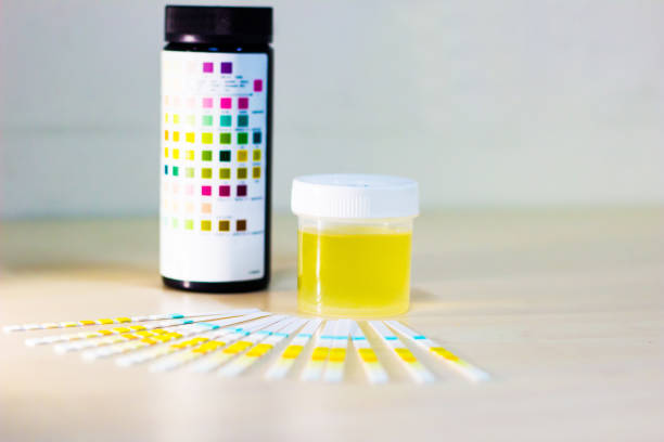 istock urine sample along with dip stick uristix for analyzing urine glucose protein in diabetes 957698790