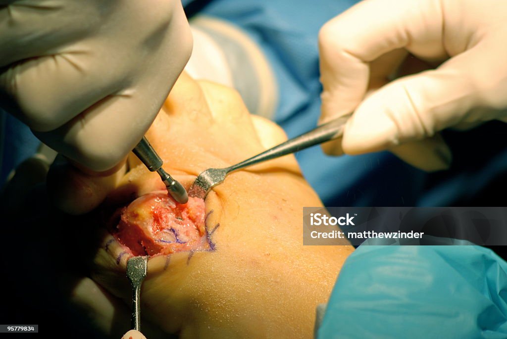 Shaving 침울 뼈다귀 in bunionectomy - 로열티 프리 발톱 스톡 사진