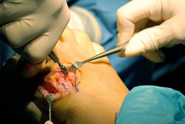 barbear para baixo osso bunionectomy - podiatrist podiatry orthopedic surgeon human foot imagens e fotografias de stock