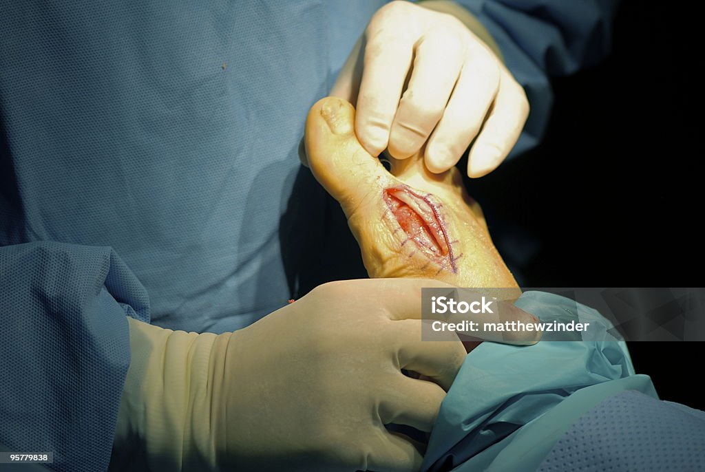 Cirurgia após correcção para o joanete - Royalty-free Cirurgia Foto de stock