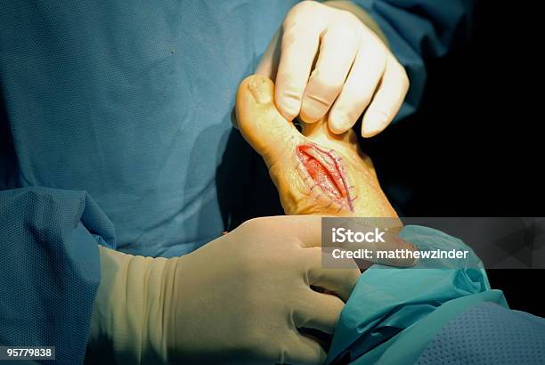 Cirurgia Após Correcção Para O Joanete - Fotografias de stock e mais imagens de Cirurgia - Cirurgia, Cirurgião ortopédico, Coluna vertebral humana