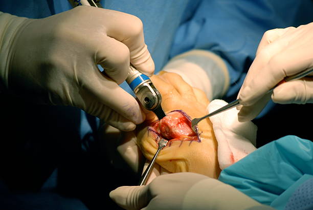 reduzir inflamações com serra cirúrgica - podiatrist podiatry orthopedic surgeon human foot - fotografias e filmes do acervo