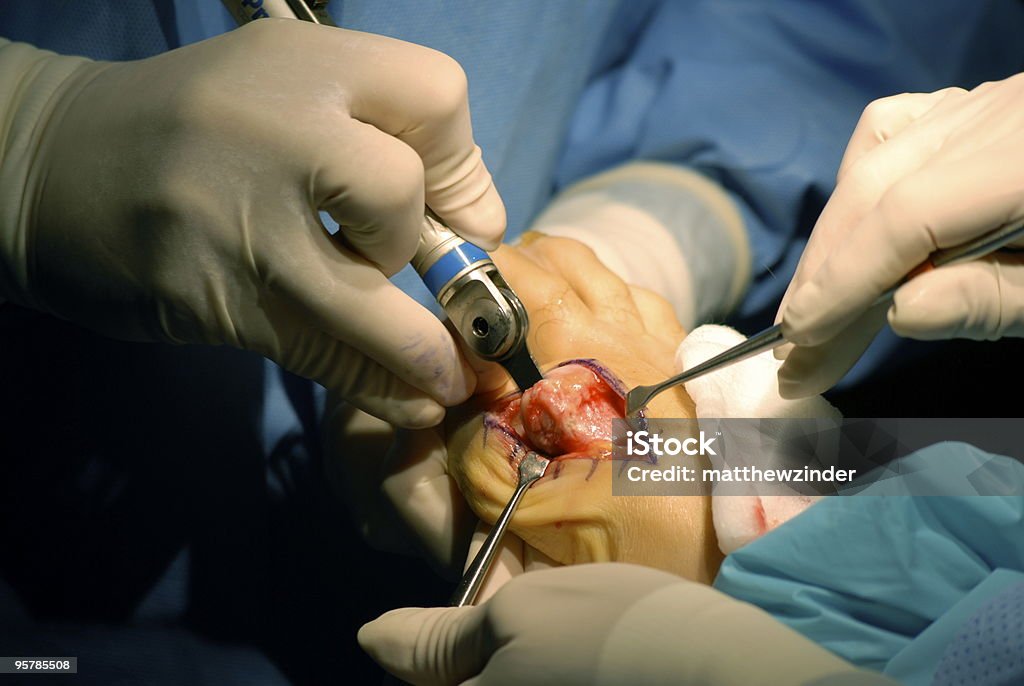Вальгусная деформация первого пальца стопы резания с Хирургическая пила - Стоковые фото Операция роялти-фри