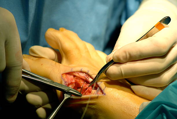 시작 닽힌 - bunion bunions human foot podiatry 뉴스 사진 이미지