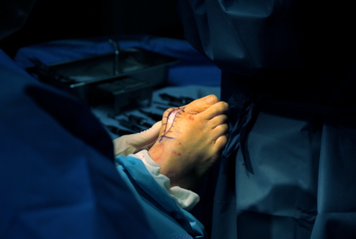 Abierto de incisión durante la cirugía juanete photo