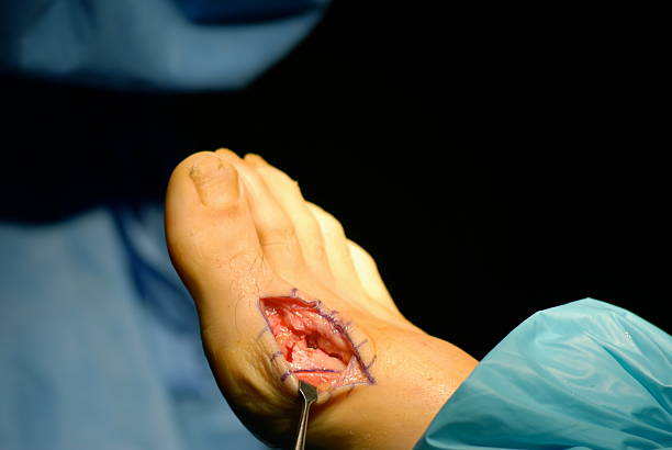 joanete cirurgia post correção - podiatrist podiatry orthopedic surgeon human foot - fotografias e filmes do acervo