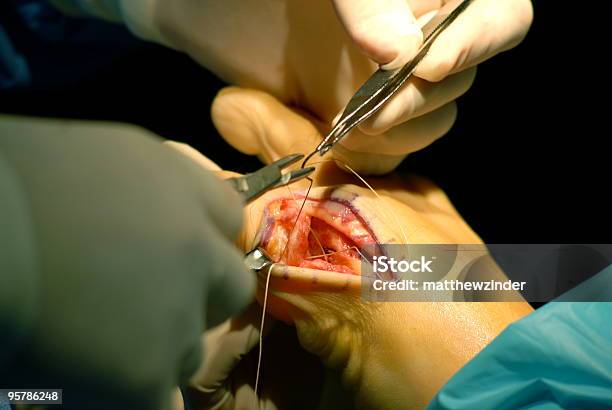 クロージング手術用巻線 - 手術のストックフォトや画像を多数ご用意 - 手術, 腱膜瘤, カラー画像