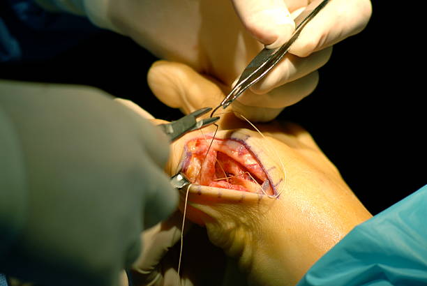 fechamento encerramento cirúrgica - podiatrist podiatry orthopedic surgeon human foot - fotografias e filmes do acervo
