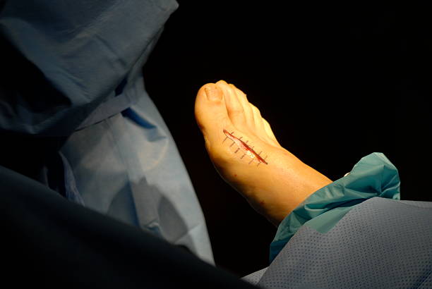 incision für bunionectomy chirurgie - podiatrist orthopedic surgeon podiatry surgical equipment stock-fotos und bilder