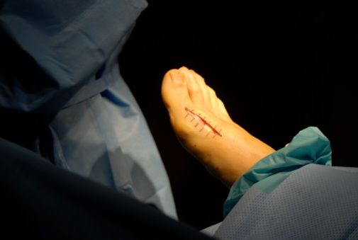 INCISIÓN bunionectomy de la cirugía photo