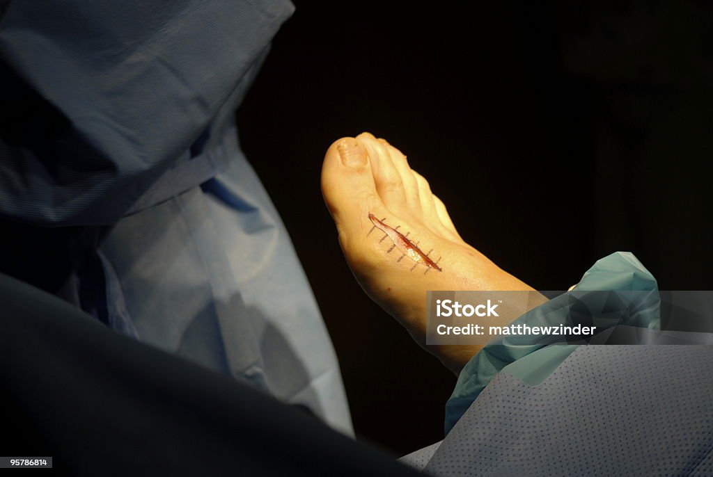 INCISIÓN bunionectomy de la cirugía - Foto de stock de Abrazadera libre de derechos