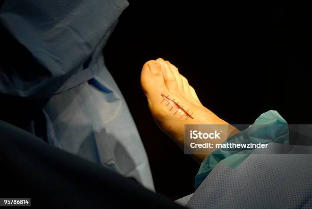 Incisión Bunionectomy De La Cirugía Foto de stock y más banco de imágenes de Abrazadera - Abrazadera, Cirugía, Cirujano ortopédico