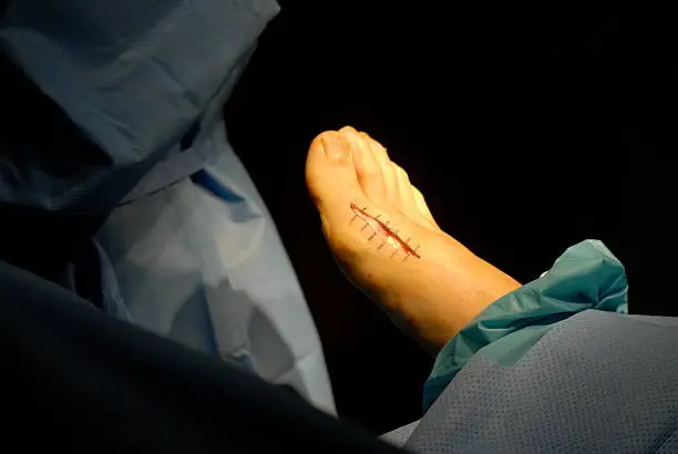 Photo of Incision for bunionectomy surgery