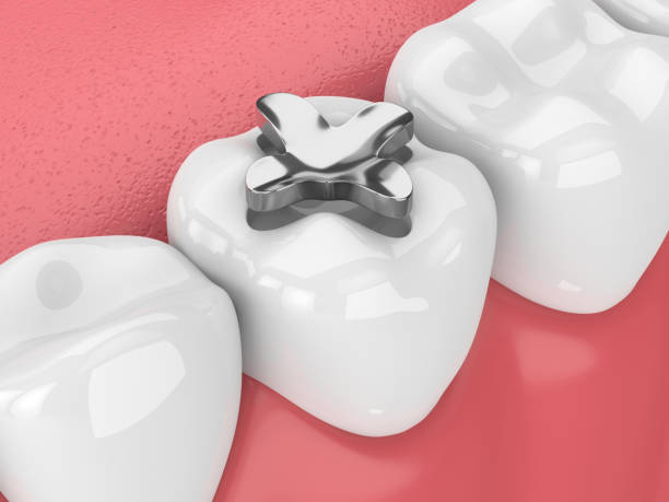 istock 3d render of teeth with dental amalgam inlay filling 958030282