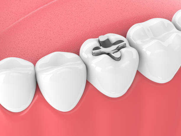 istock 3d render of teeth with dental inlay filling 958030540
