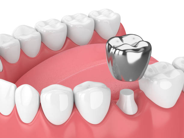 istock 3d render of teeth with dental crown amalgam filling 958030988