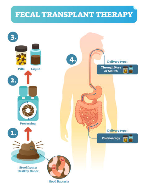 지저분한 이식 치료, 절차 단계 다이어그램, 벡터 일러스트 레이 션. 인간의 소화 microflora 갱신 - fecal coliform bacteria stock illustrations