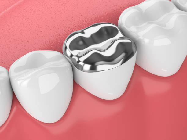 istock 3d render of teeth with dental onlay amalgam filling 958068796