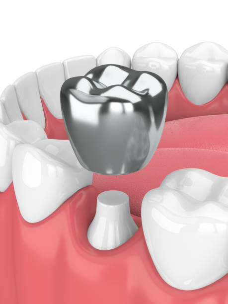 istock 3d render of teeth with dental crown amalgam filling 958069262