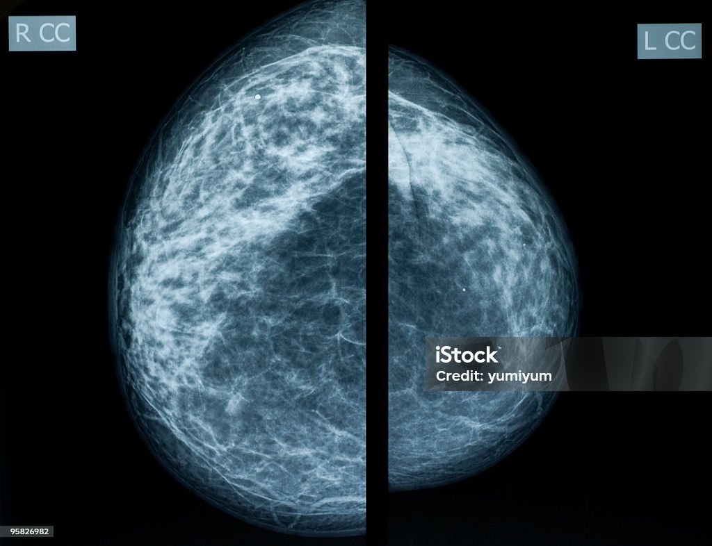 Mammografia - Zbiór zdjęć royalty-free (Anatomia człowieka)