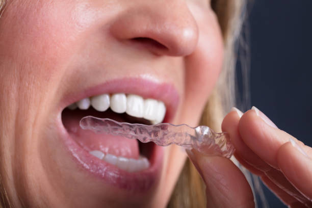 istock Woman Wearing Clear Aligner 958335898