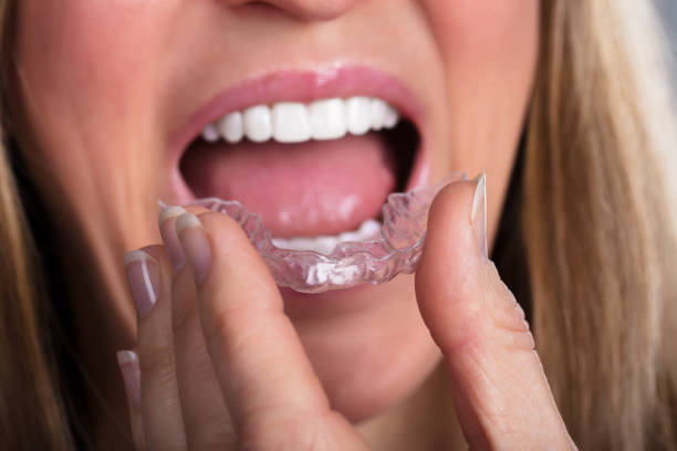 istock Woman Wearing Clear Aligner 958335912