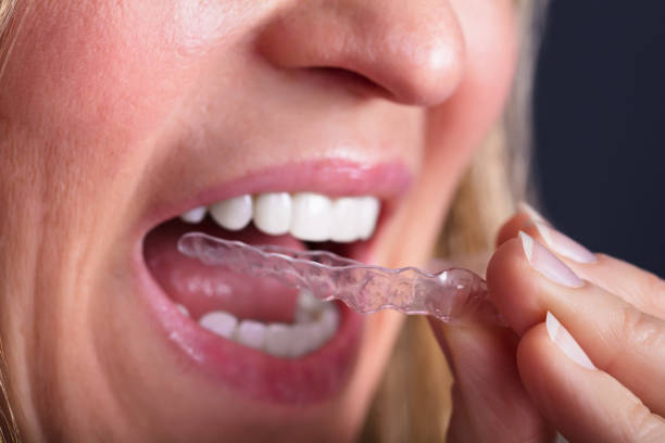 istock Woman Wearing Clear Aligner 958335924