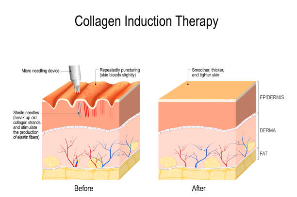 Collagen induction therapy Collagen induction therapy (microneedling) is a surgical for remove wrinkles, scars, stretch, marks, pigmentation. skin needling procedure, repeatedly puncturing the skin with tiny, sterile needles (microneedling the skin). skin exame stock illustrations