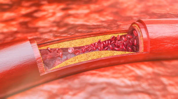 Cross section through an artery with occlusive disease Anatomical correct cross section through arteriosclerosis. atherosclerosis stock pictures, royalty-free photos & images
