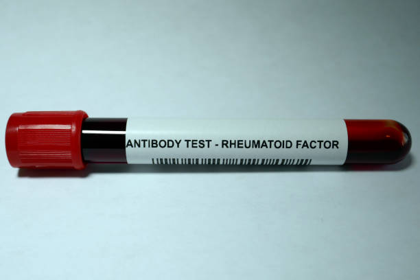 Rheumatoid factor Rheumatoid factor - laboratory analysis performed on a blood sample that is extracted from a vein in the arm using a hypodermic needle and vacutainer. autoantibody stock pictures, royalty-free photos & images