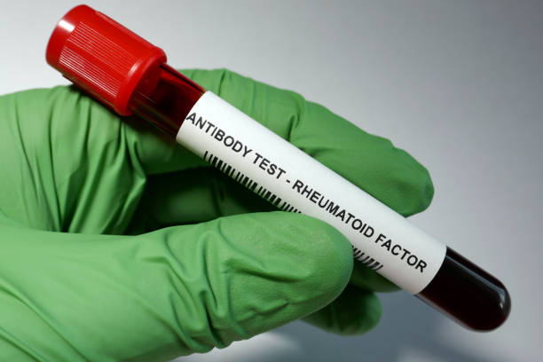 Rheumatoid factor blood test Rheumatoid factor - laboratory analysis performed on a blood sample that is extracted from a vein in the arm using a hypodermic needle and vacutainer. autoantibody stock pictures, royalty-free photos & images