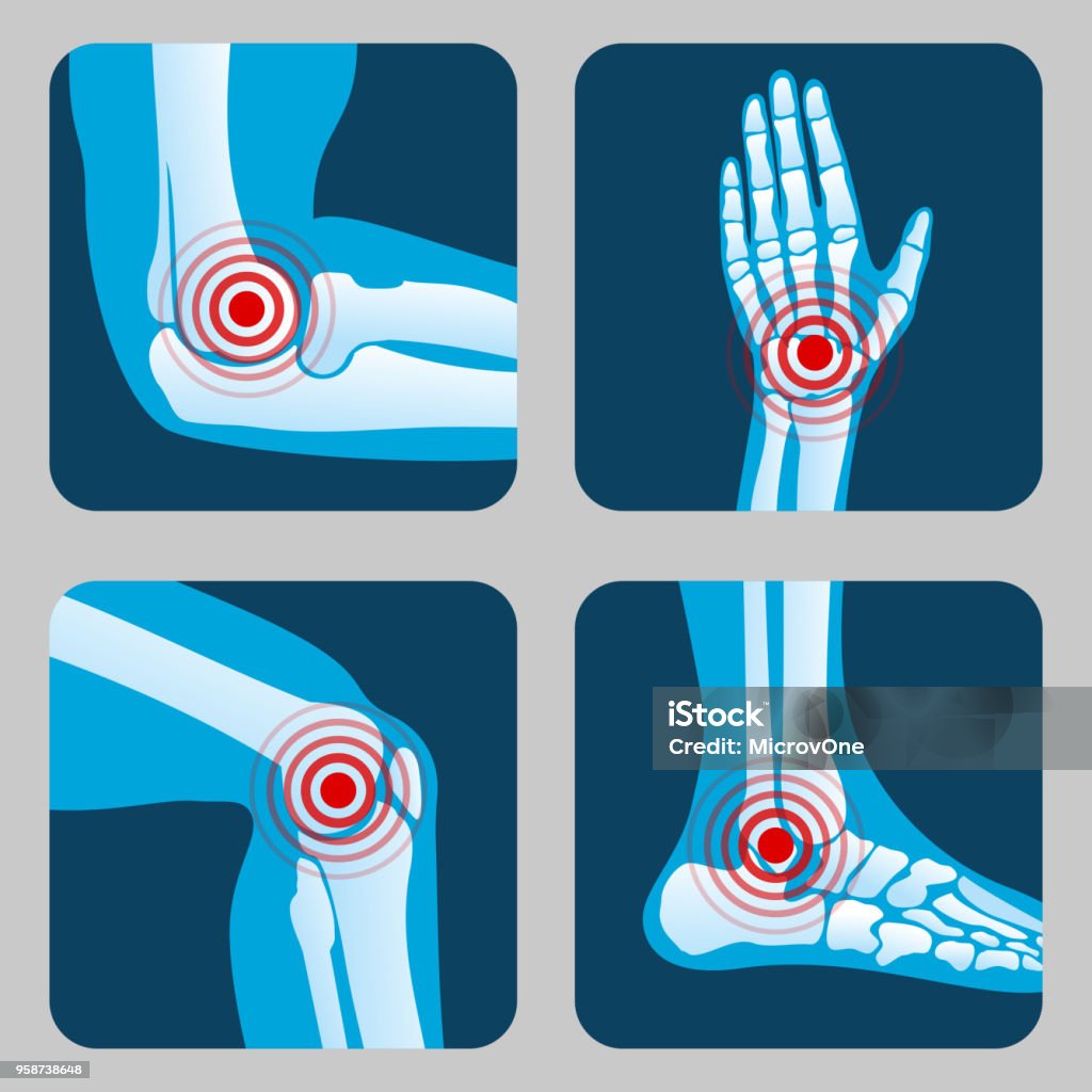 Human joints with pain rings. Arthritis and rheumatism infographic. Medical app vector buttons Human joints with pain rings. Arthritis and rheumatism infographic. Medical app vector buttons. Disease in joint bone, knee, leg and hand illustration Pain stock vector