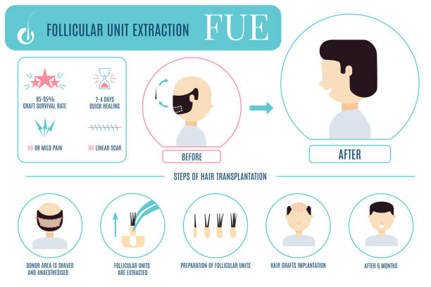 kuvapankkikuvitukset aiheesta fue-hoidon infografiikka miehille - receding hairline