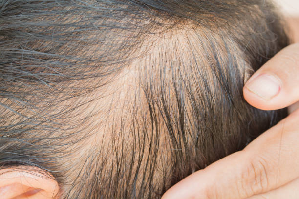 istock Thin  hair and scalp  and broken hair 959045886