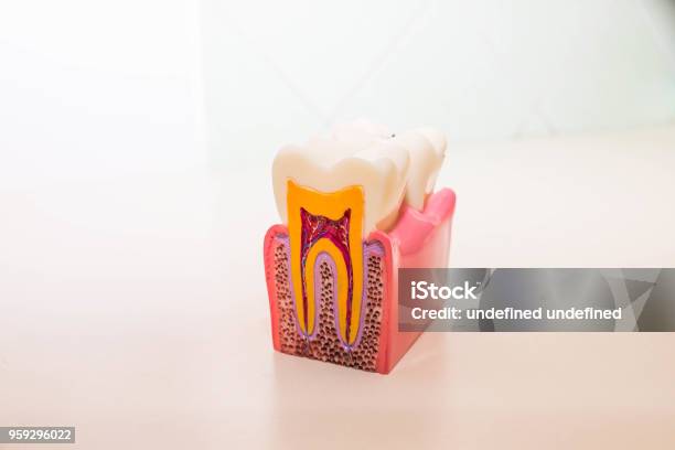 Zahnmodell Ohne Karies Karies In Zahnarztpraxis Gesunde Zähnekonzept Kinder Zahnarzt Textfreiraum Stockfoto und mehr Bilder von Endodontie