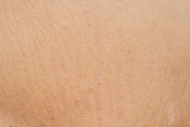 istock Stretch marks on the skin, wrinkles, 959464382