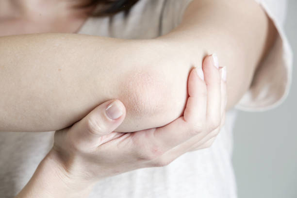 winterizing dry itchy skin on the elbow area - elbow imagens e fotografias de stock